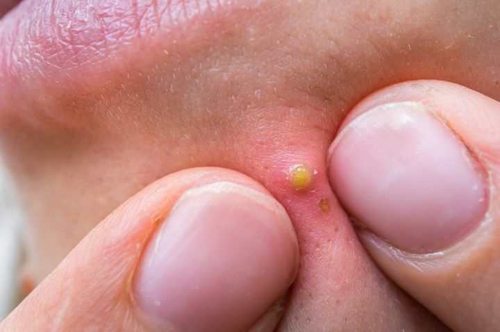 popping pimple